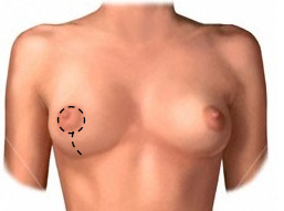 Keyhole Mastopexy Procedure