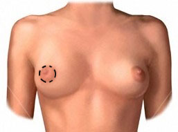 Donut Mastopexy Procedure