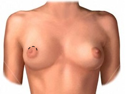 Nipple incision at top of areola